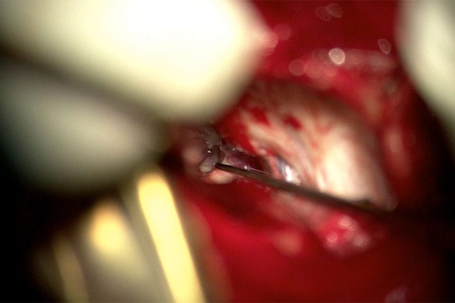 Microvascular Decompression